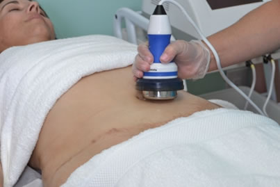 ULTRASOUND CAVITATION
